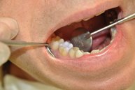 Abb. 2: Einprobe der noch blauen Keramik im Mund an Zahn 46 (= erster Backenzahn im rechten Unterkiefer).